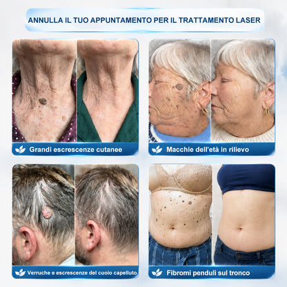 𝐏i𝐜𝐝o® 🔊 Soluzione mirata di 7 giorni per la cura degli acrocordoni e delle imperfezioni cutanee (Applicazione indolore con roll-on, senza lasciare segni)
