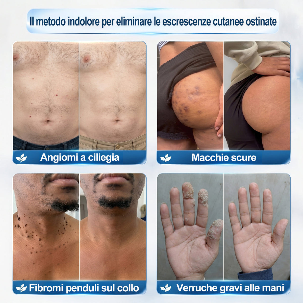 𝐏i𝐜𝐝o® 🔊 Soluzione mirata di 7 giorni per la cura degli acrocordoni e delle imperfezioni cutanee (Applicazione indolore con roll-on, senza lasciare segni)