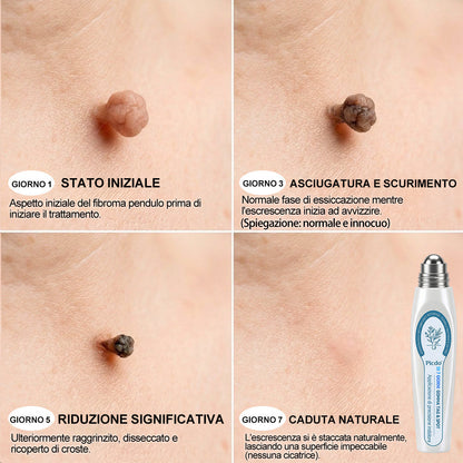 𝐏i𝐜𝐝o® 🔊 Soluzione mirata di 7 giorni per la cura degli acrocordoni e delle imperfezioni cutanee (Applicazione indolore con roll-on, senza lasciare segni)